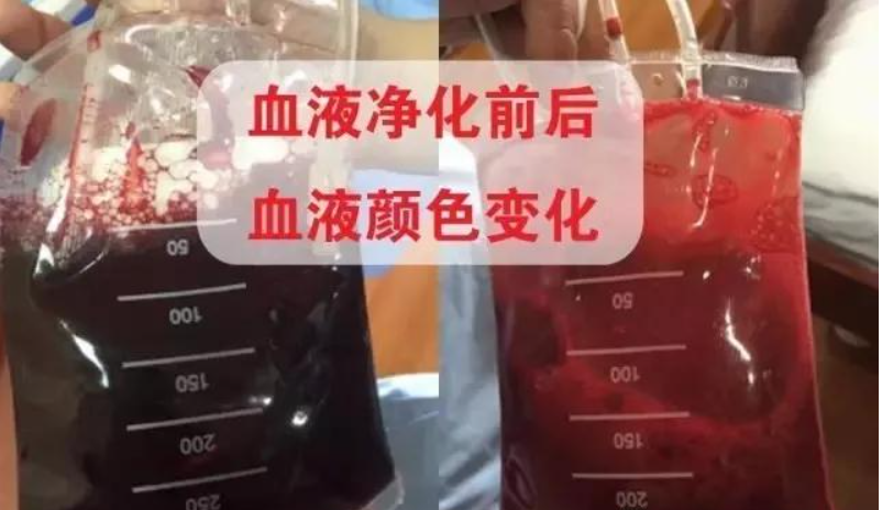 血液净化应该做几次