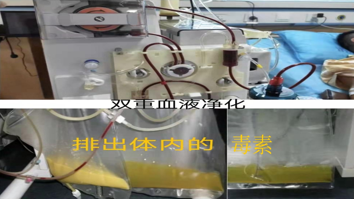 血液净化做几回有效？