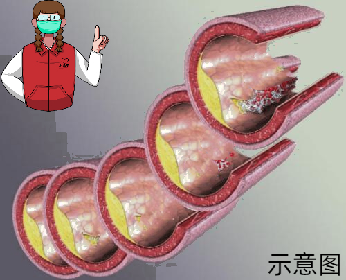 血管堵塞危害大