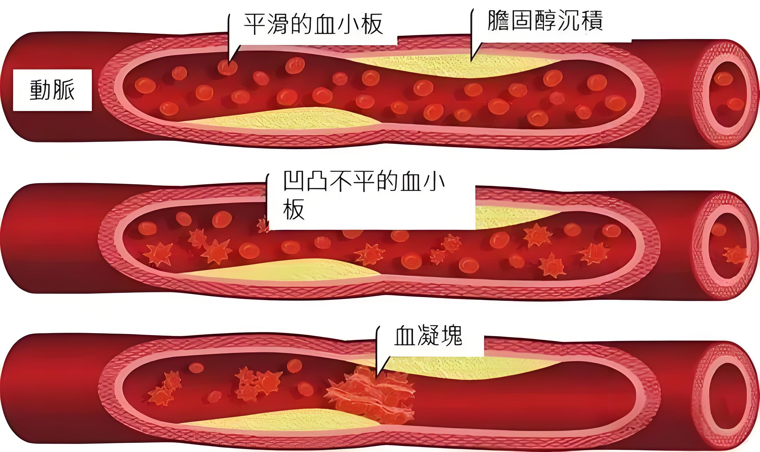 血管堵塞的三个脸部症状