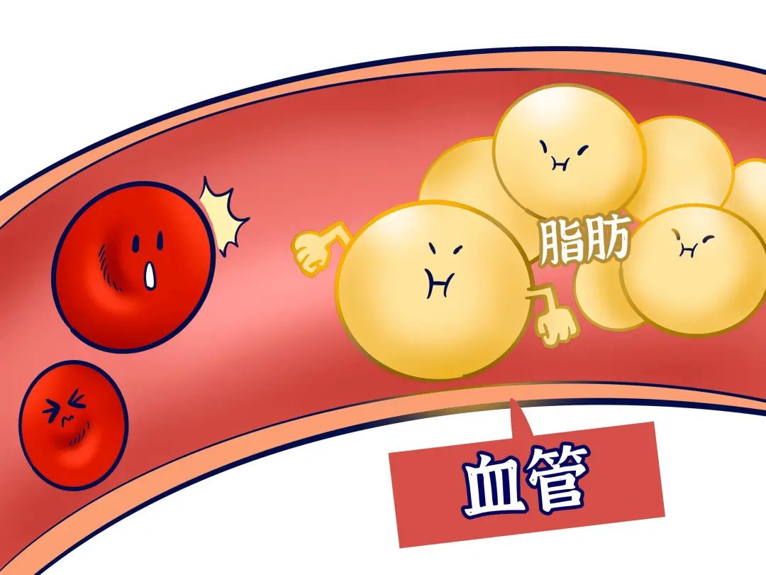 血脂异常是引发心脑血管病的主要危险因素