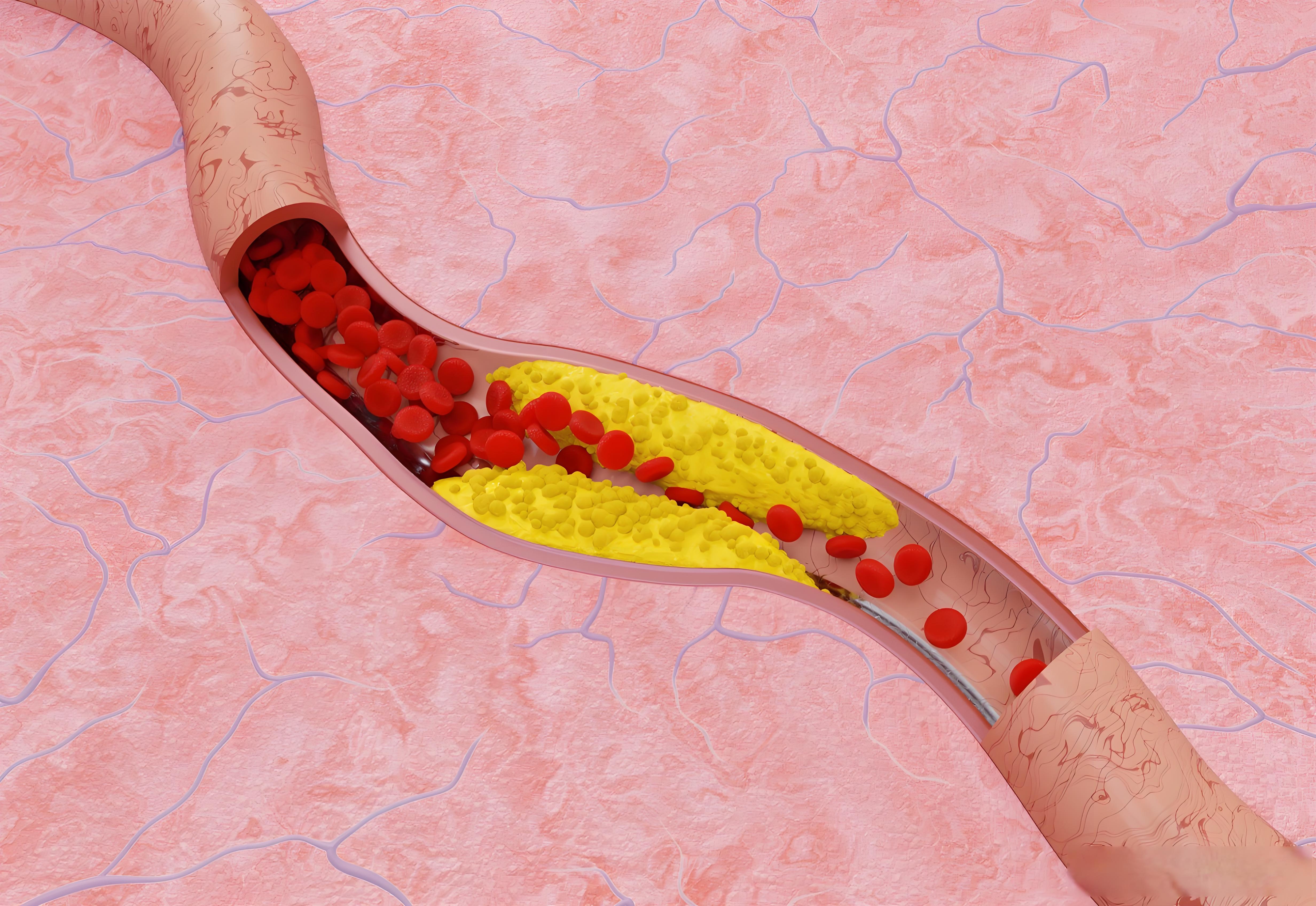 血管堵了，手脚会有信号